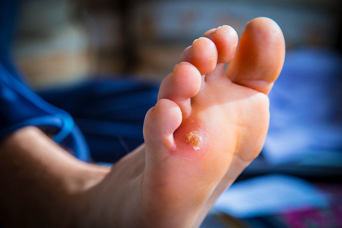 Hammertoes in Naperville, IL  Illinois Podiatry Specialists